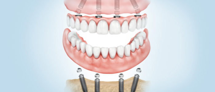 dentadura fijada con implantes dentales en Terrassa