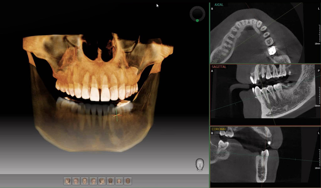 Lo último en dentadura fijada con implantes dentales en Terrassa