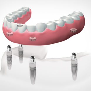 implantes dentales dentadura extraíble