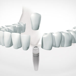 implantes dentales unitarios