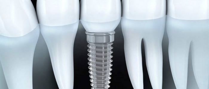 implantología dental en Terrassa