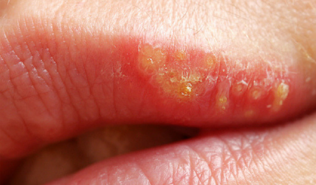 infección de boca en Terrassa
